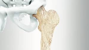 Osteoporosis and Crohn's Disease | AICA Jonesboro