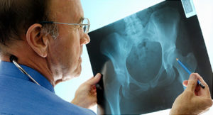 Innovations In Regenerative Medicine Shown To Reduce Hip Pain | AICA Jonesboro