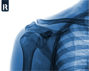 shoulder injury