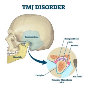 TMJ Chiropractor